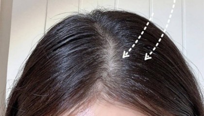 缓解毛囊炎的洗发水是什么牌子的??无屑社交货币