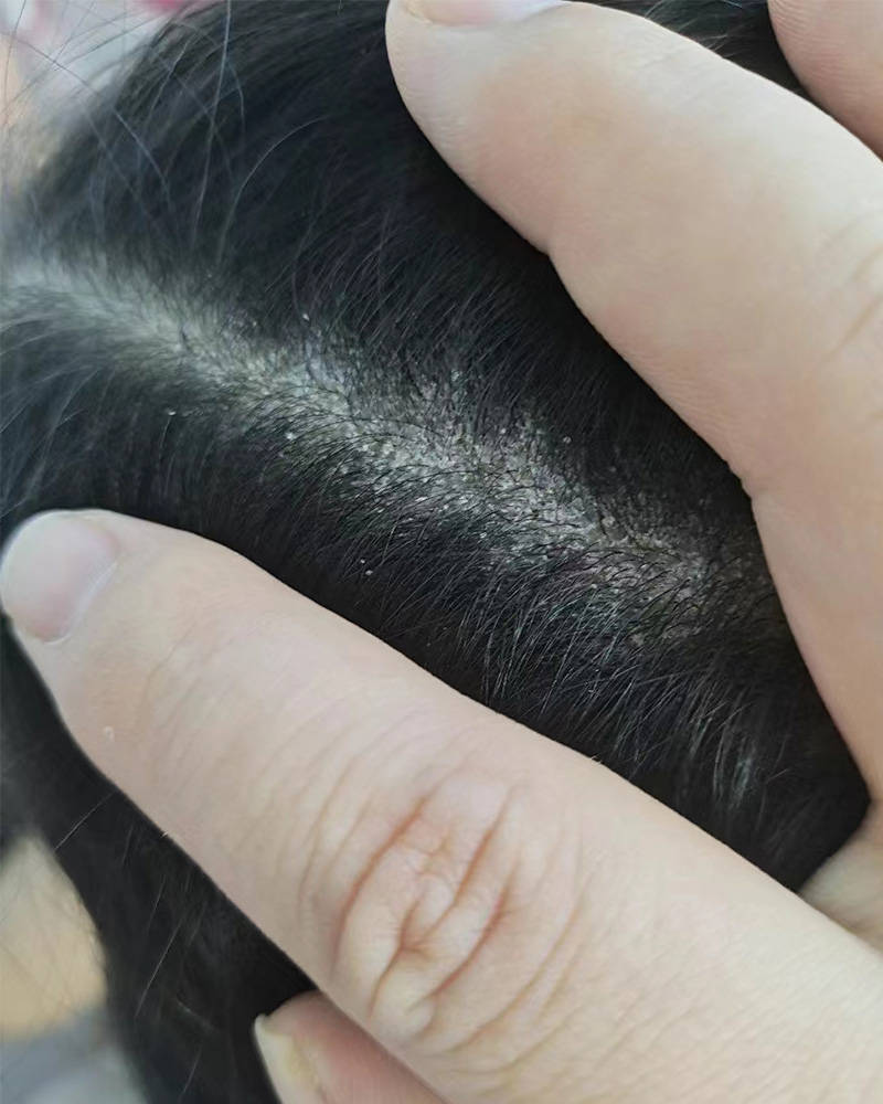 头皮毛囊炎用什么样的洗发水??无屑社交货币