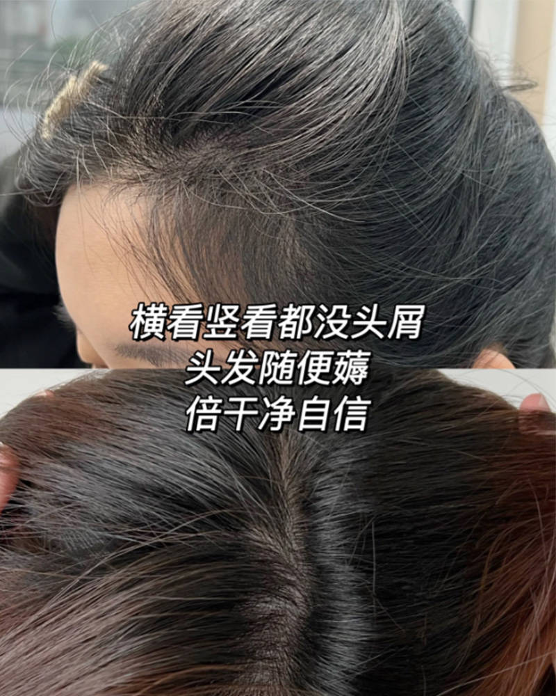 头皮毛囊炎用什么样的洗发水??无屑社交货币